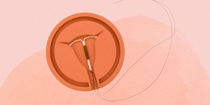 How is IUD Removed