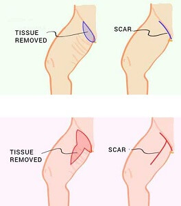 Thigh Lift Explained