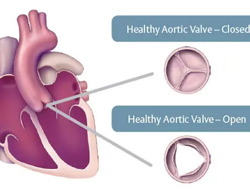 Aortic Valve Replacement Surgery Cost