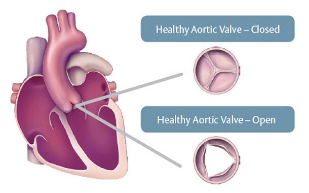 Aortic Valve Replacement Surgery Cost