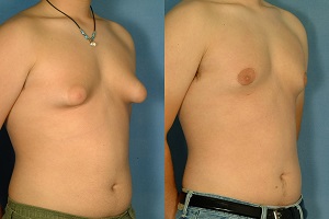 Gynecomastia Before and After