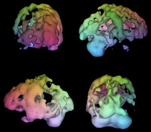 Brain SPECT Results