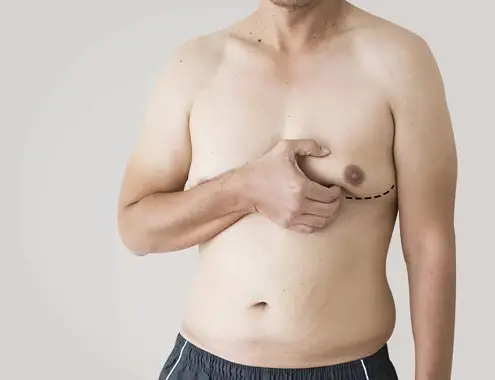 Gynecomastia Surgery Cost