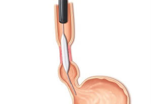 Esophageal Dilation Explained