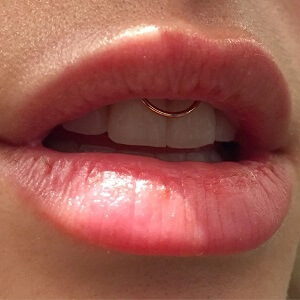 Smiley Piercing