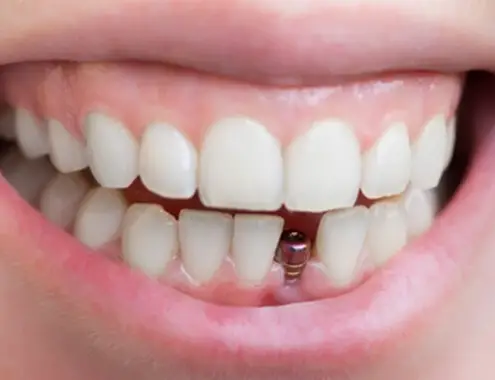 Mini Dental Implants Cost