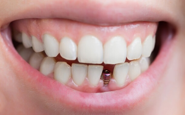 Mini Dental Implants Cost