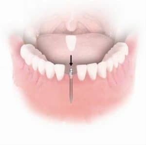 Mini Dental Implants Explained