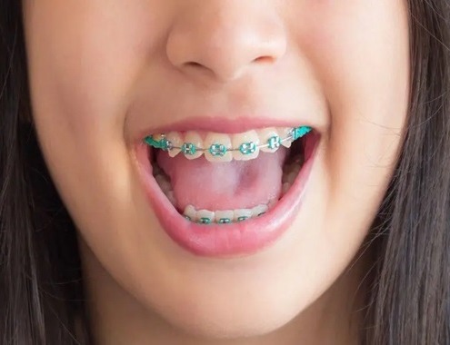 How much do children's braces cost