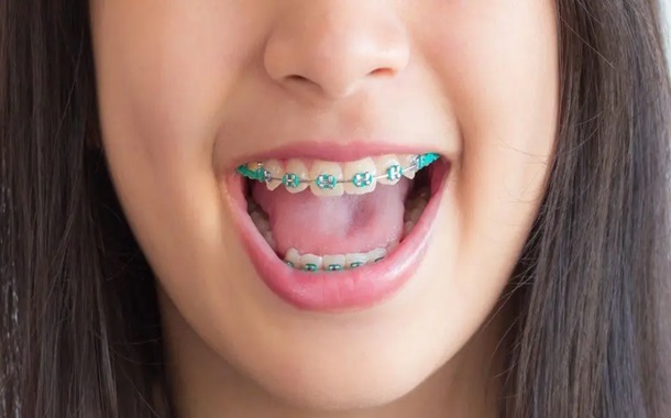 How much do children's braces cost