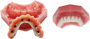 Snap-in Dentures Explained