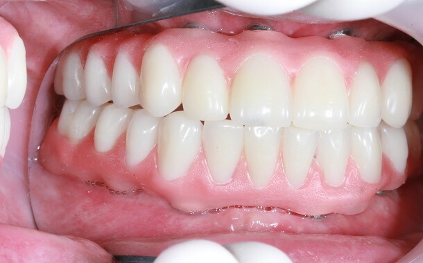 Full Mouth Dental Implants Cost