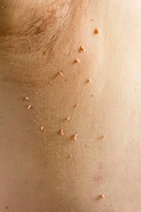 Skin Tag Removal 