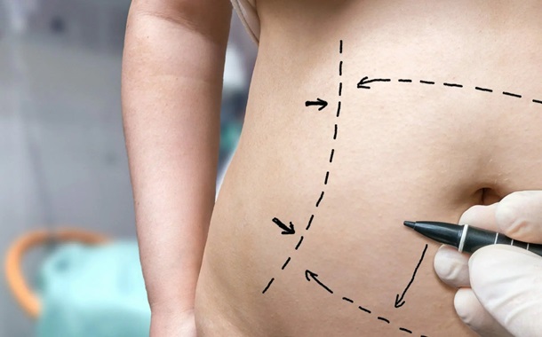 Tummy Tuck Cost