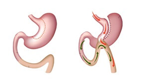 Mini Gastric Bypass Surgery