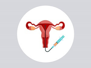 Intrauterine Insemination