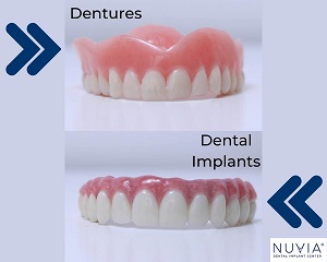 Nuvia Dental Implant
