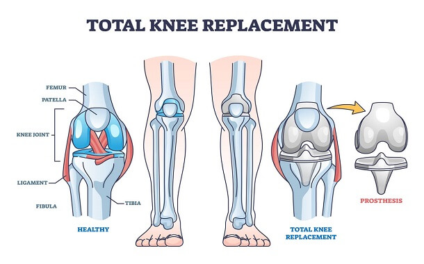 Knee Replacement Cost
