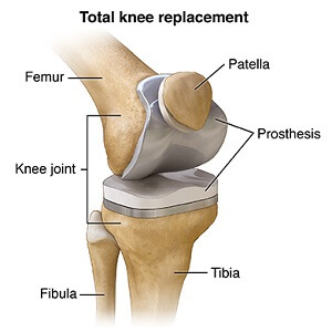 Knee Replacement Surgery