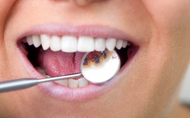 Lingual Braces Cost