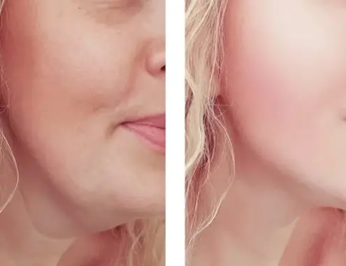 Laser Double Chin Removal Cost