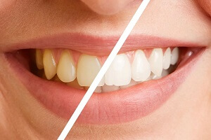 Zoom Whitening