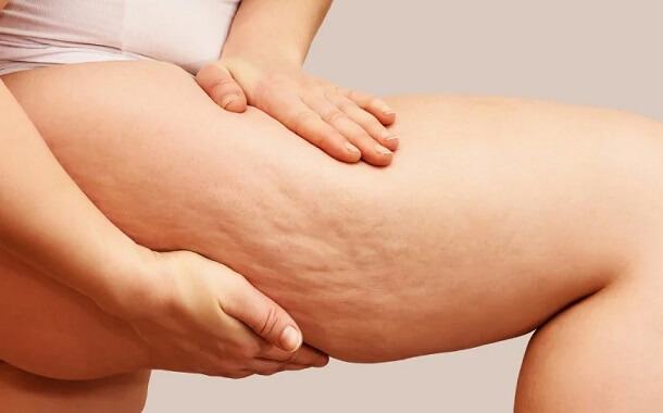 Lipedema Surgery Cost