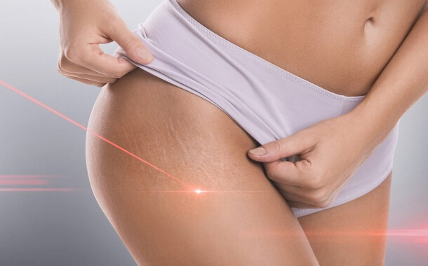 Laser Stretch Mark Removal Cost