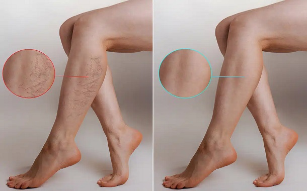 Varicose Vein Removal Cost