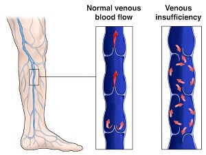 Chronic Venous Insufficiency Treatment