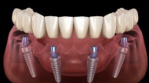 How Much Do All-on-4 Dental Implants Cost?