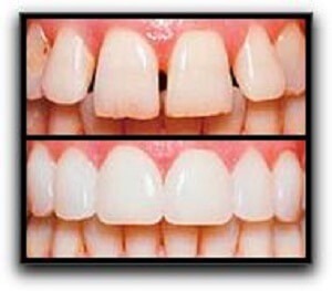 Prepless Veneers Cost