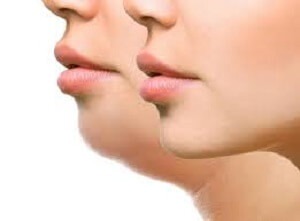 Coolsculpting Chin Cost 