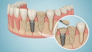Dental Bone Graft Cost