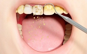 Dental Deep Cleaning