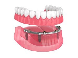 Implant Supported Dentures 