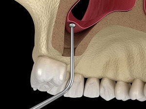 Dental Sinus Lift