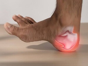 Heel Spur Treatment 