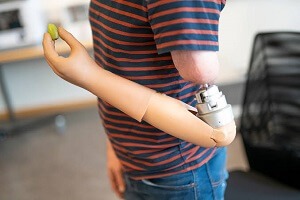 Prosthetic Arm